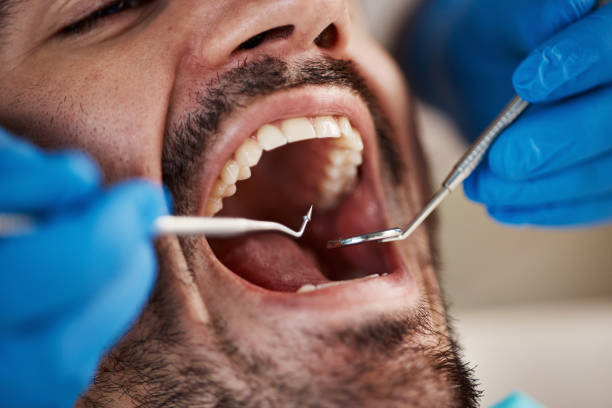 Best Emergency Dentist for Lost Fillings or Crowns in Conehatta, MS